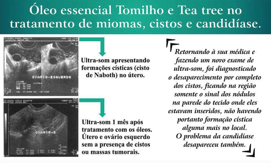 RELATO - Mioma e Cistos: Tratamento com Óleo de Tomilho e Melaleuca